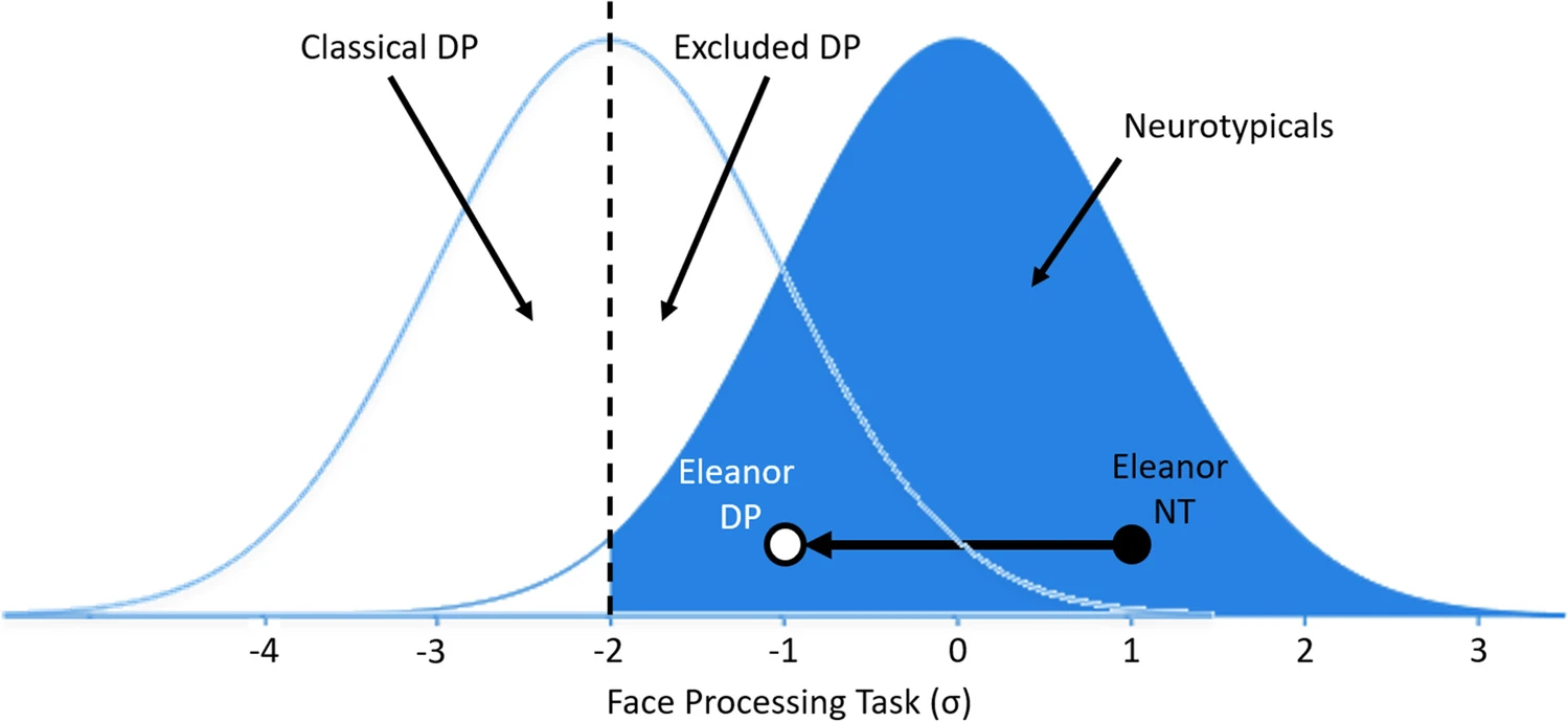 Hypothetical distributions of performance in prosopagnosia. The left distribution represents the performance of individuals with prosopagnosia, and the blue distribution the performance of neurotypical individuals. The dotted line represents the threshold for determining that an individual has prosopagnosia. 